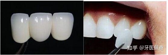 遇到锥形牙怎么办一起来了解一下吧