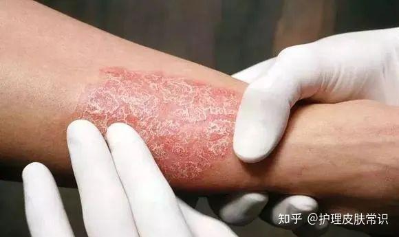 【肤康·科普】神经性皮炎阵发性瘙痒该怎么治疗? - 知乎