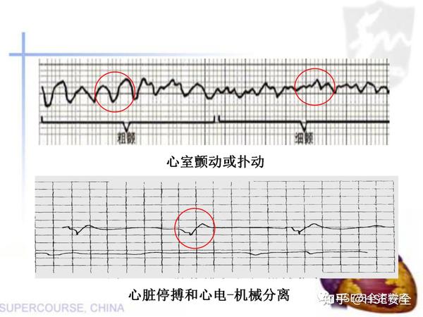 PPT |【课件】新版心肺复苏课件 - 知乎