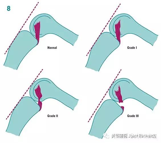 后交叉韧带起止点图解图片