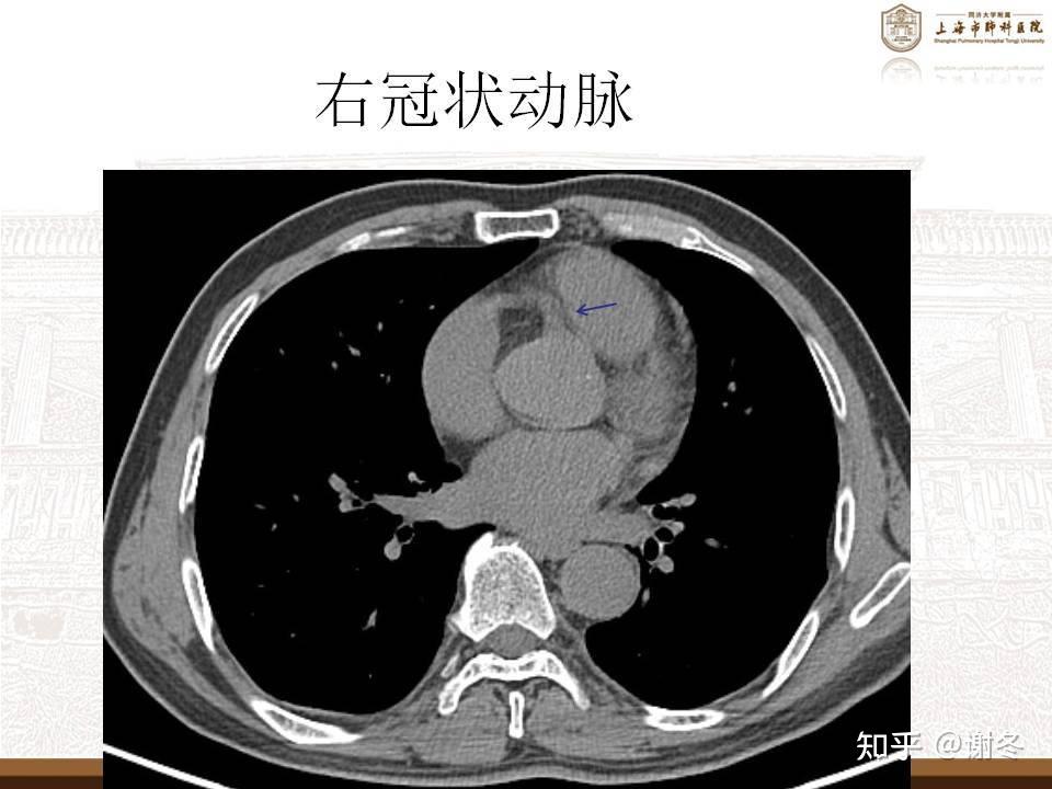 冠状动脉解剖图钙化图片