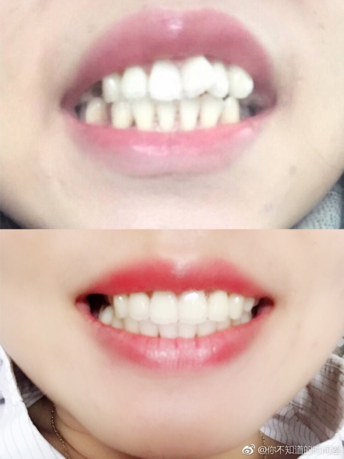 正畸分享蝴蝶牙拔了四颗牙戴陶瓷牙套完成牙齿矫正