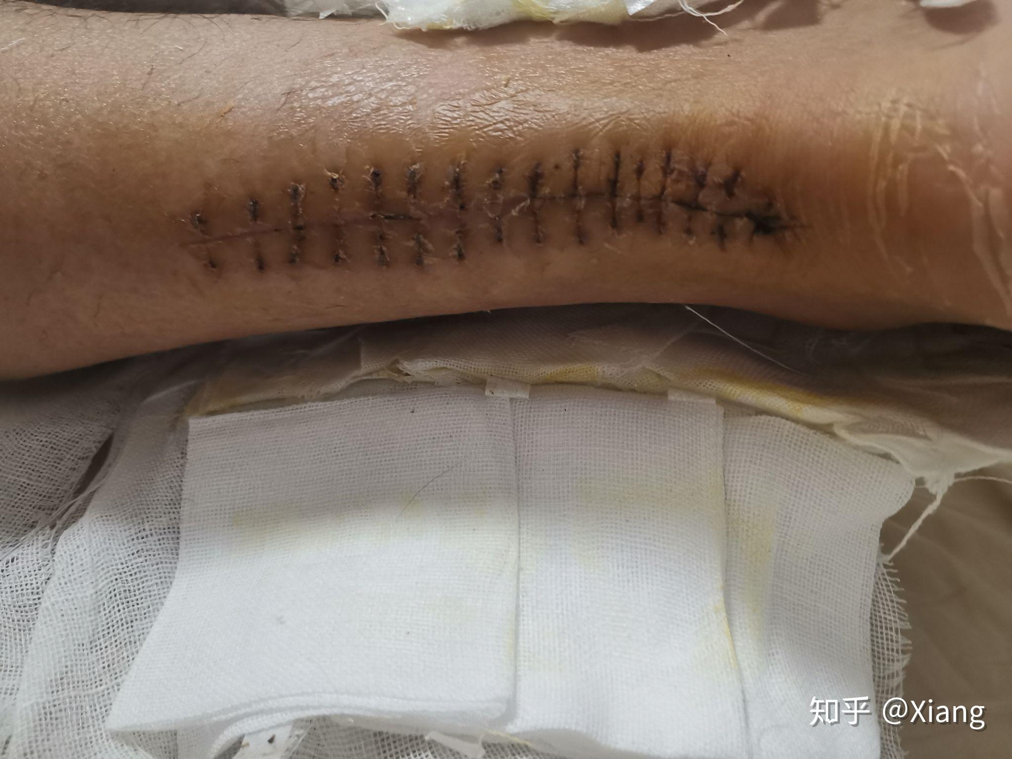 跟腱断裂后的笑面人生