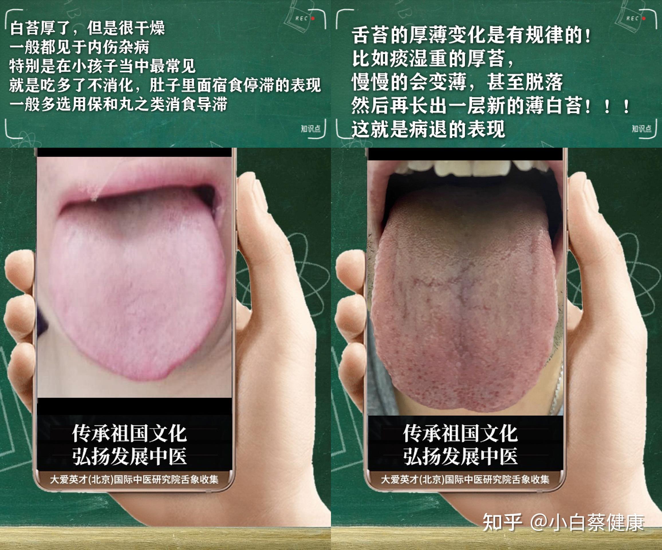 中医实解:脸没有光泽,痰火扰心,大便干结,满脸油腻 - 知乎