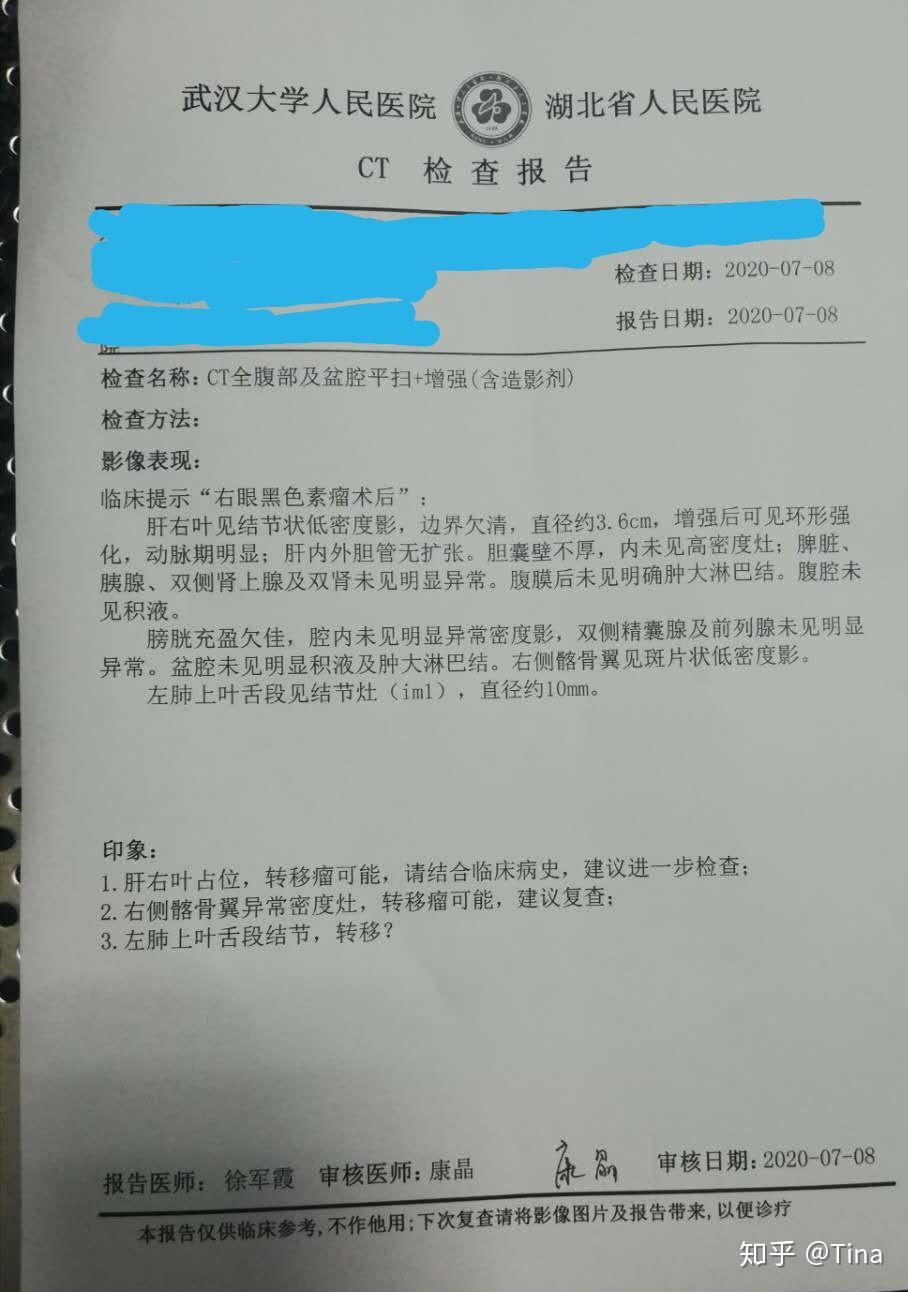 眼睛恶性黑色素瘤 - 知乎