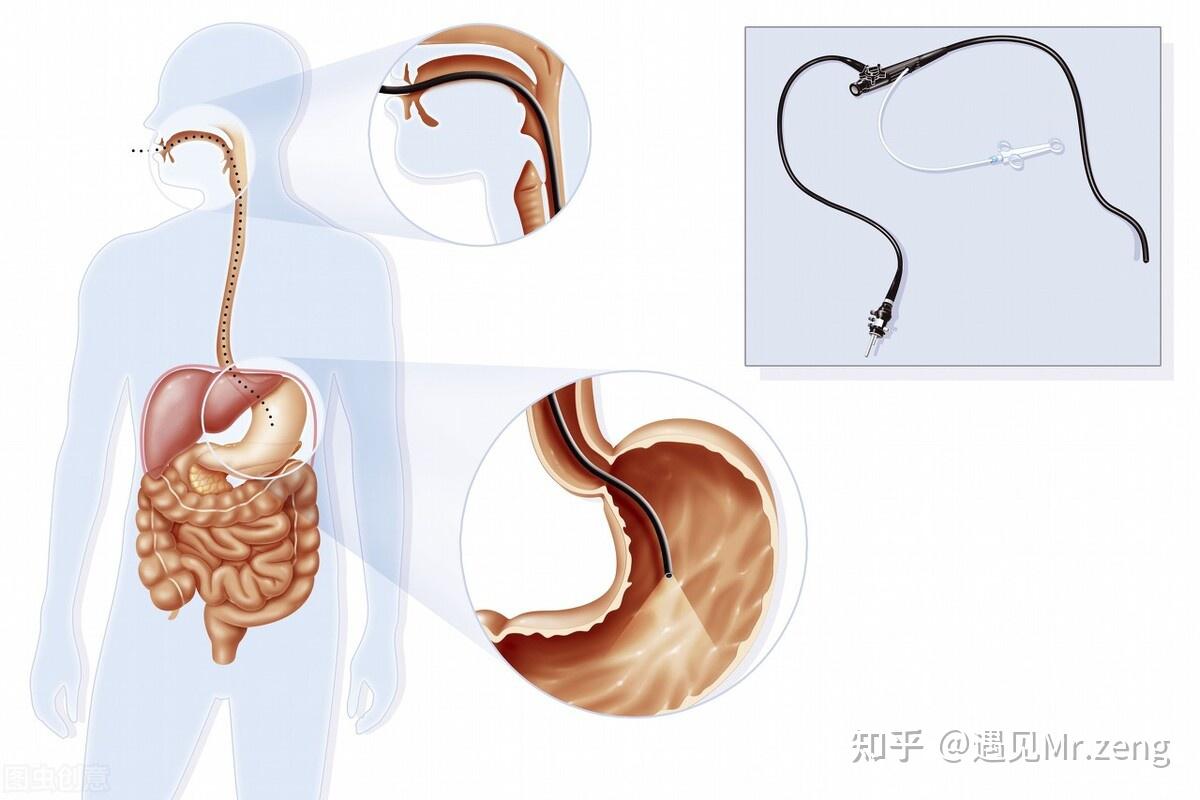 40歲之前為什麼要做胃鏡檢查做胃鏡檢查是一種什麼體驗