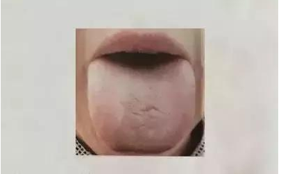 看舌识病技巧 ，一分钟看图学会老中医的舌诊诀窍，在家也能自检 - 知乎