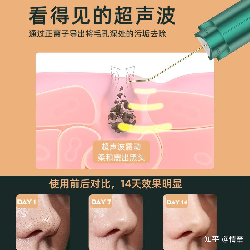 毛孔堵塞怎么清理全是闭口粉刺