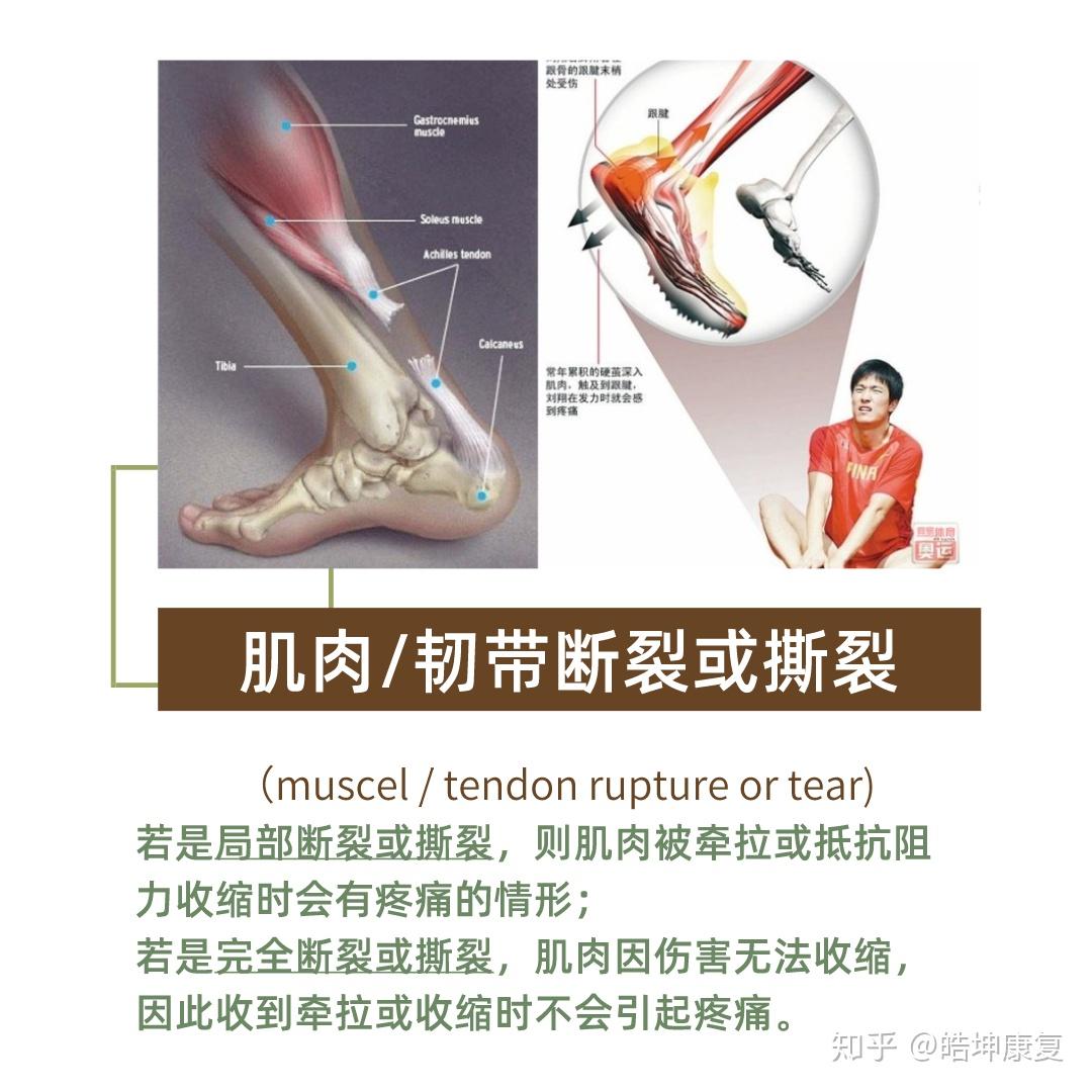 肌肉撕裂 - 知乎