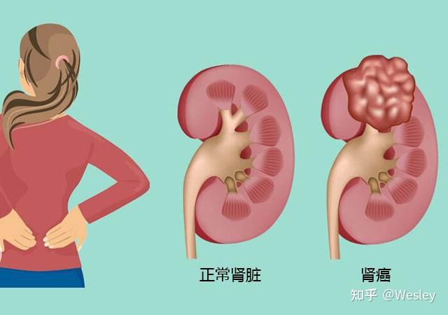 肾癌早期常见的3大症状是什么