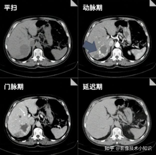 肝海绵状血管瘤的影像诊断