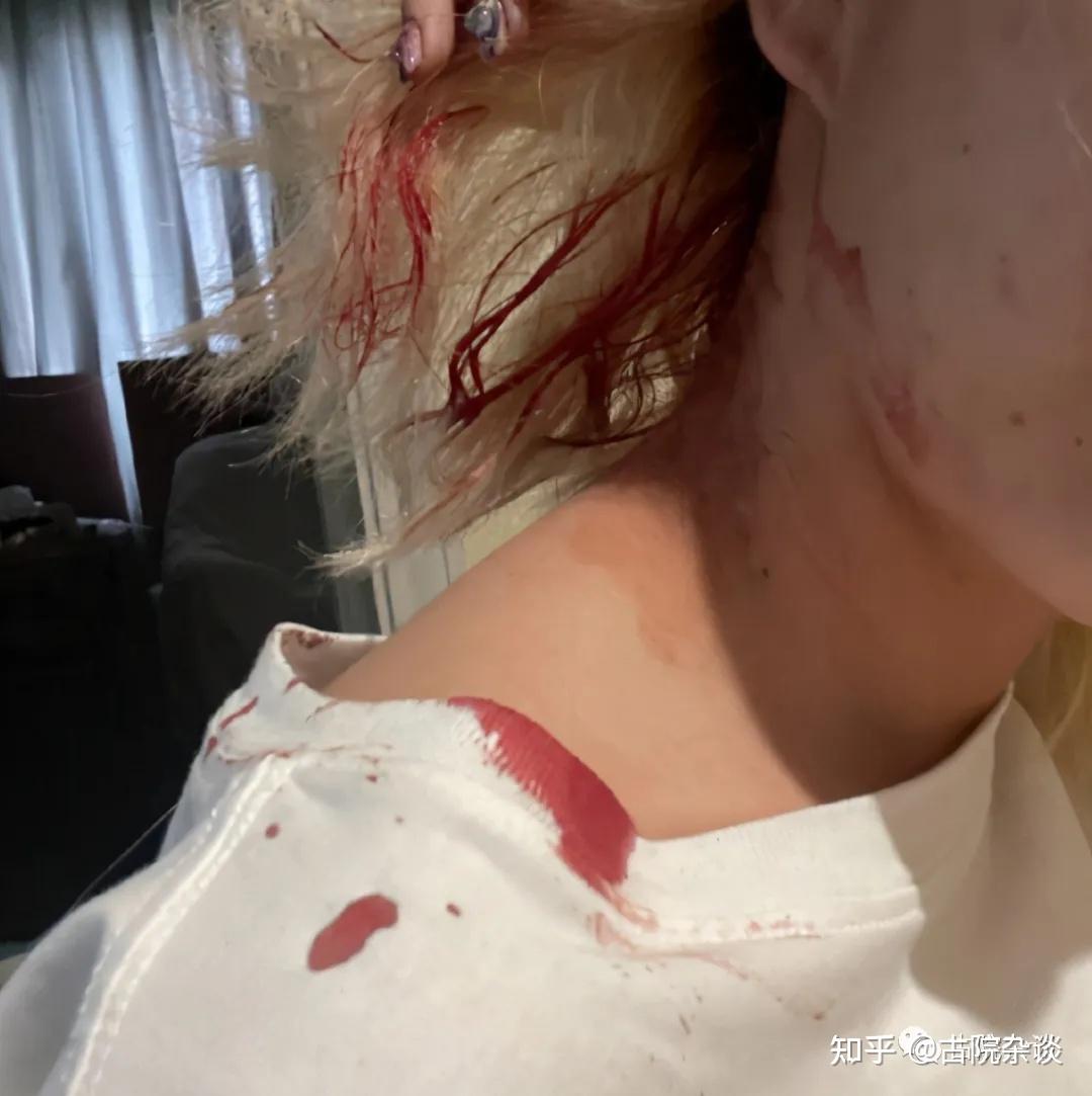 知名网红公开被家暴画面头部裂伤流血5小时男方是国家级运动健将