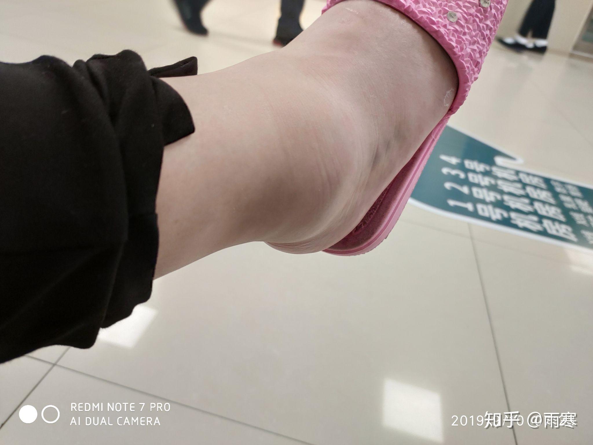 脚踝关节扭伤两个多月了,刚开始做了x线和ct没骨折就没当回事,医生也