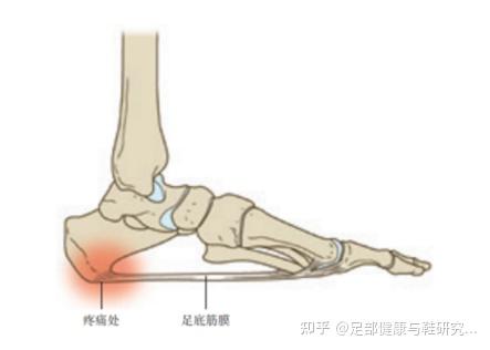 小朋友喊足跟痛，家长们应该怎么办？ - 知乎