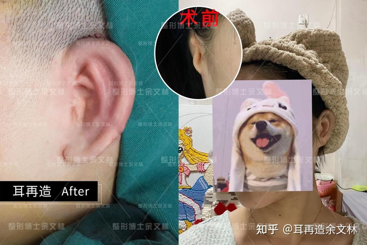 【手术效果】两期术后耳朵结构清晰,对耳轮明显,耳甲腔,耳舟深邃,外形