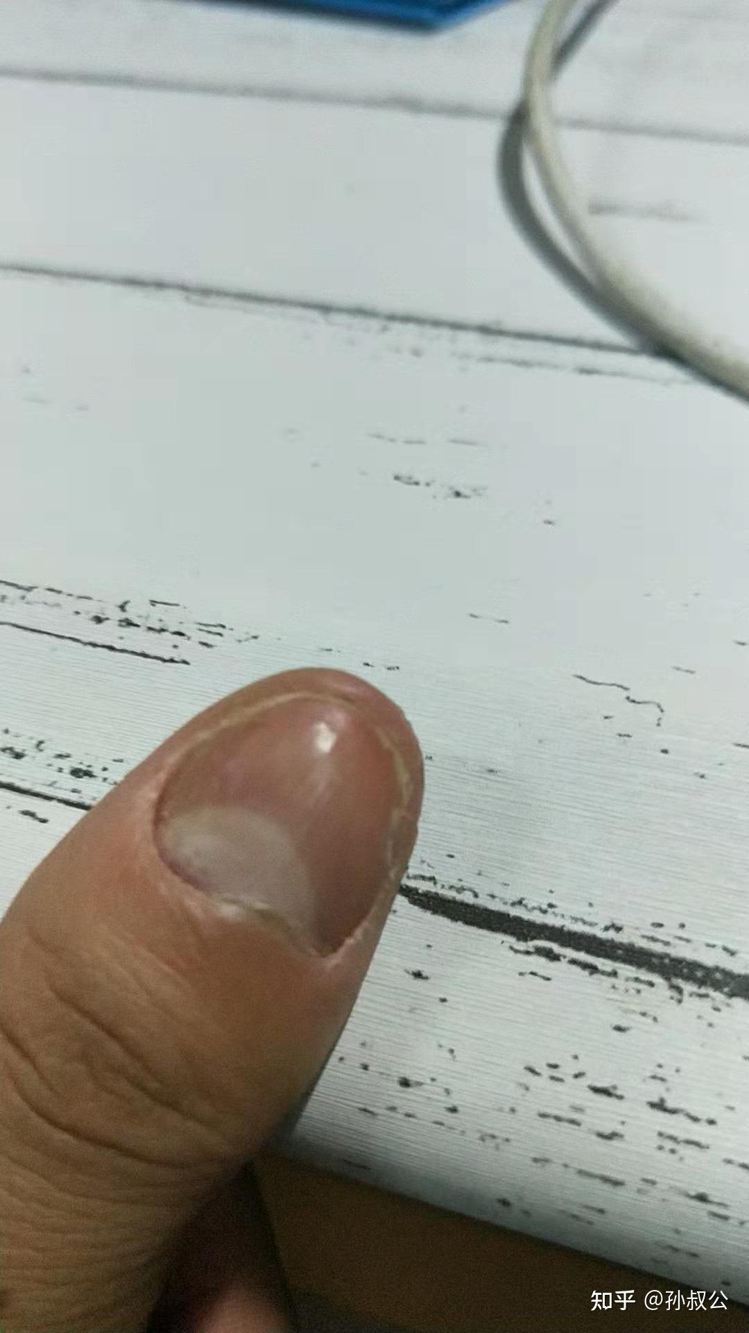 大脚趾长了双层脚趾甲,这会是灰指甲吗? - 知乎