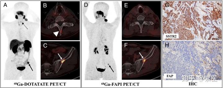 ⁶⁸Ga-DOTATATE PET/CT在检测肿瘤骨转移中的潜在价值 - 知乎