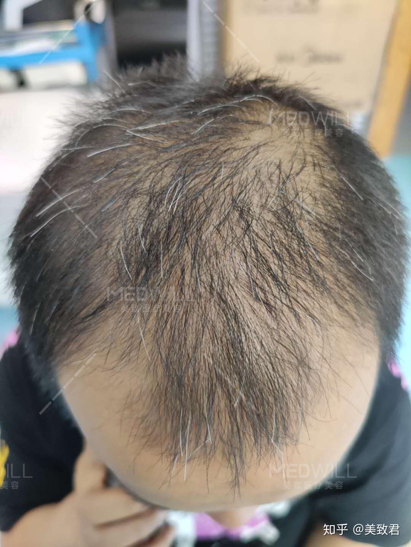 “秃”然得救,这里有适合90%以上脱发人群的生发大法! - 知乎