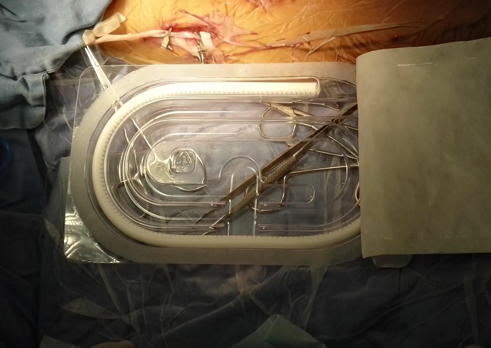 龙华医院实施我国首例国产透析用人工血管植入手术-搜狐大视野-搜狐新闻