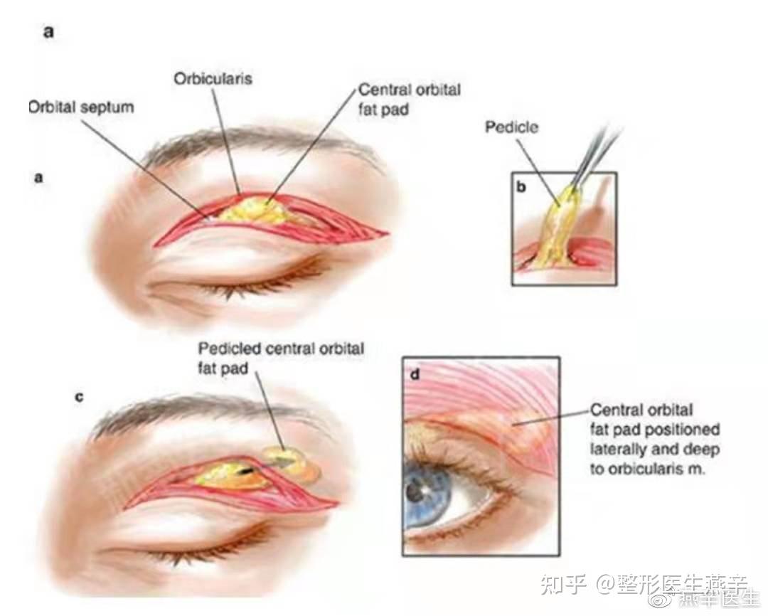 肿眼泡可以通过吸脂祛除吗?