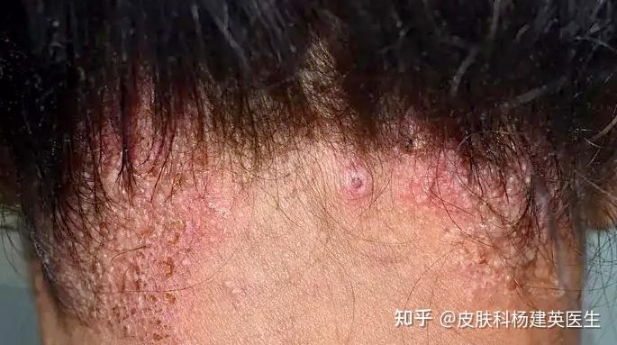 头上长痘痘、头屑还多?当心反复引起脱发! - 知乎