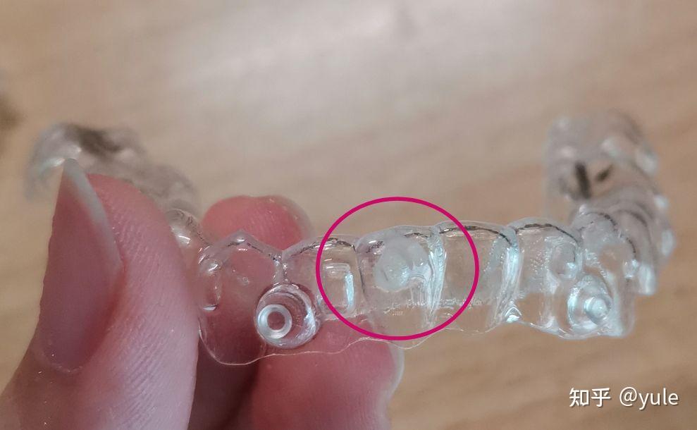 箍牙全过程隐形牙套持续更新中