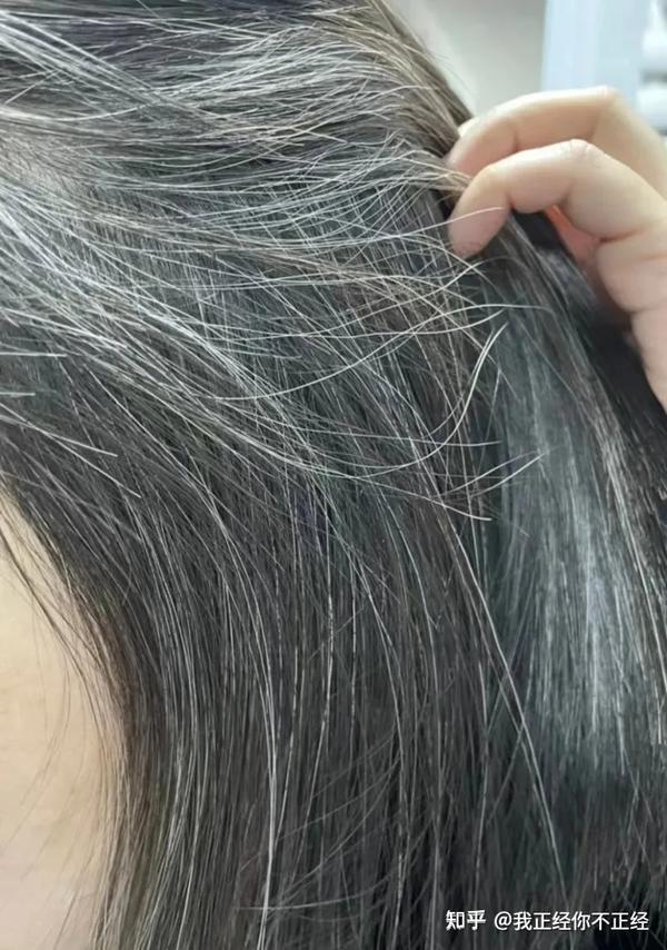 少白头,才20多岁有很多白发怎么办?还能转黑吗? - 知乎