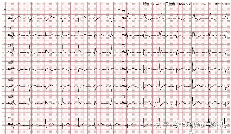 第1103期来源于中大医院心电图第1102期读图解析患者男,93岁,图为其
