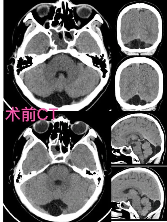 探囊取物,水到渠成神经内镜下行蛛网膜囊肿脑池联通术例纪实