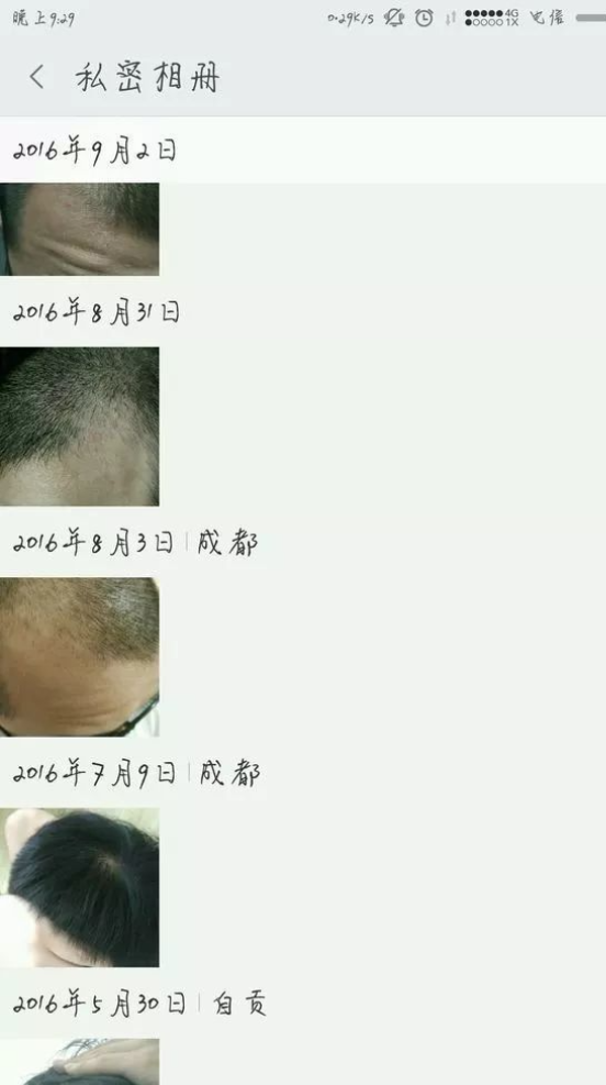 额角脱发3年,终于植发留住了发际线,术后半年效果 - 知乎