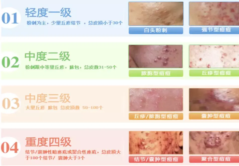 想要根治痘痘?先来了解一下诱发痘痘的根源吧! - 知乎