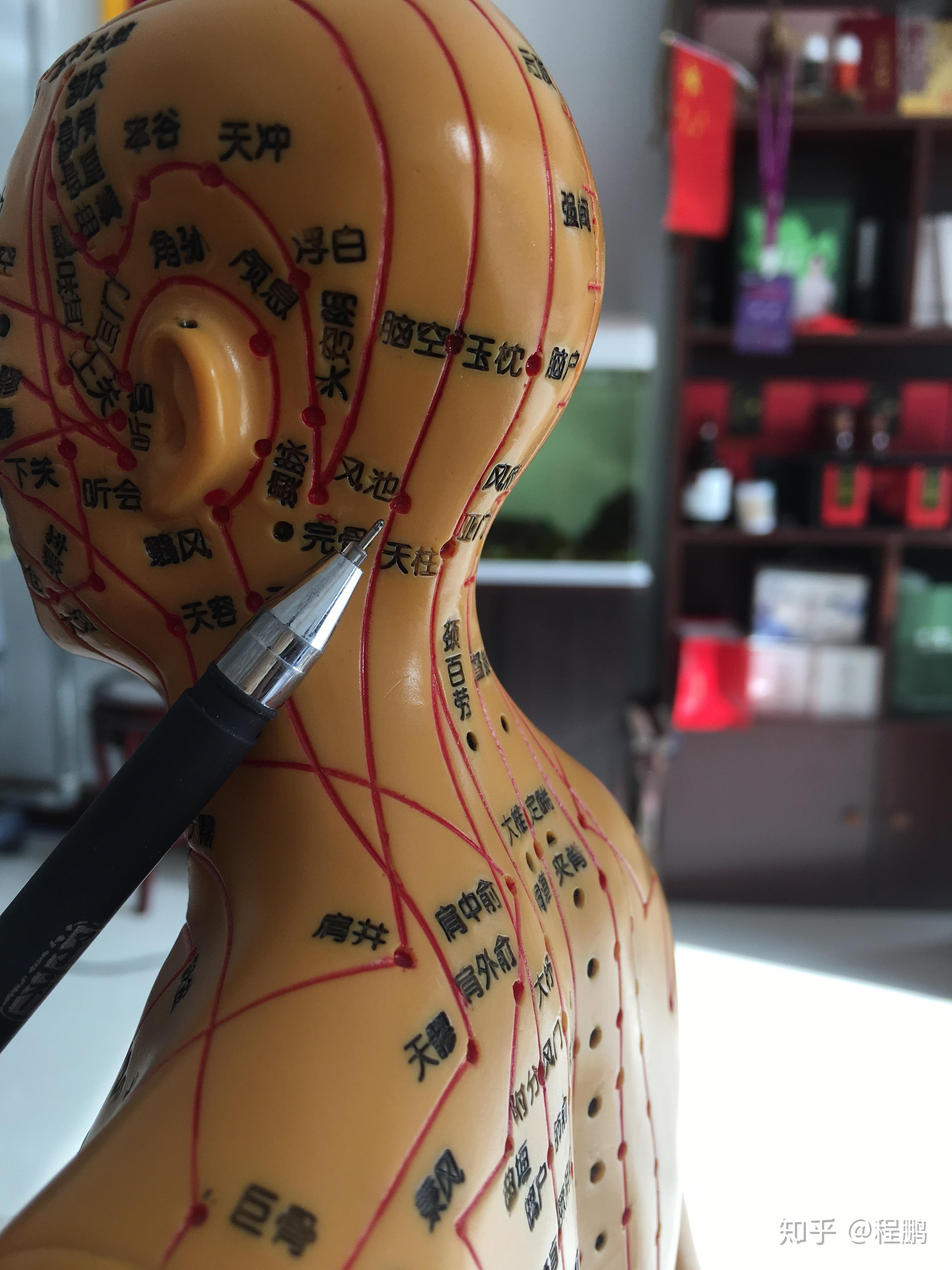 利用拔罐调理头痛问题