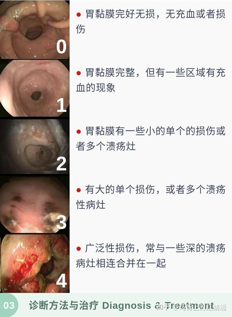 馬在前一晚開始停水停料排空胃後,使用內窺鏡進行診斷.