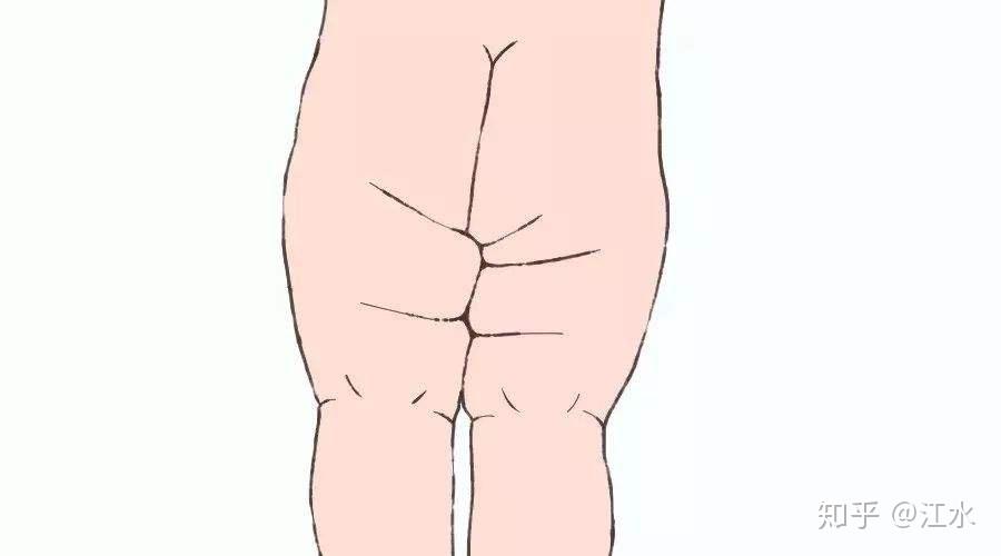 1大腿,腹股沟和臀部的皮纹是否对称,包括皮纹的数量,位置和长度2