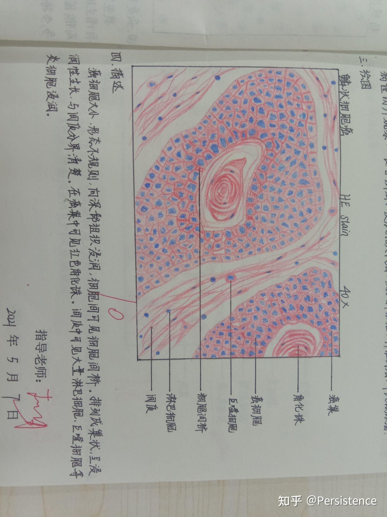 食管鳞癌病理手绘图图片