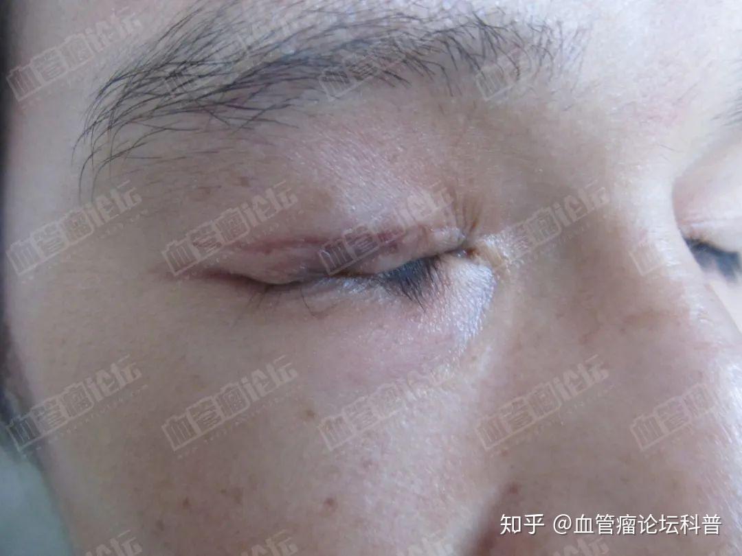 义诊案例分享小伙子上眼皮静脉畸形3次治疗后恢复