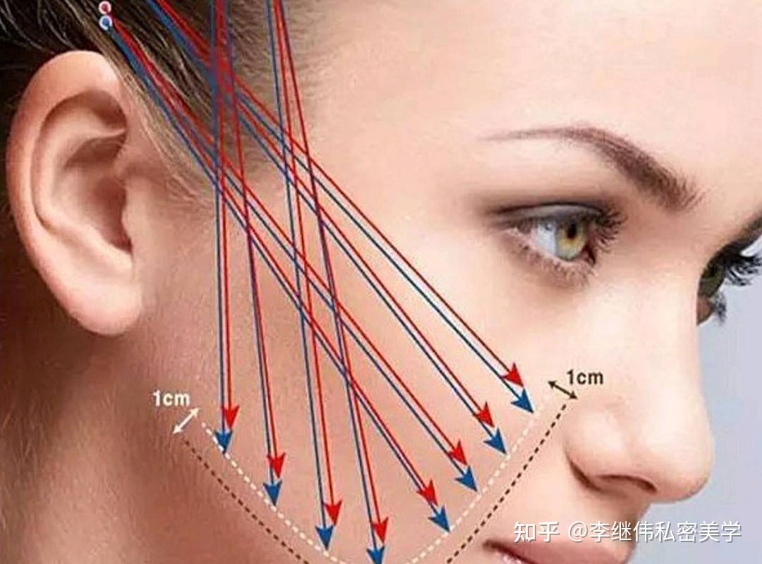 上海金环 可吸收性外科缝线/PGA缝线 4-0， 3/8，6×15,19mm,90cm,编织，涂层，无菌，1根/包