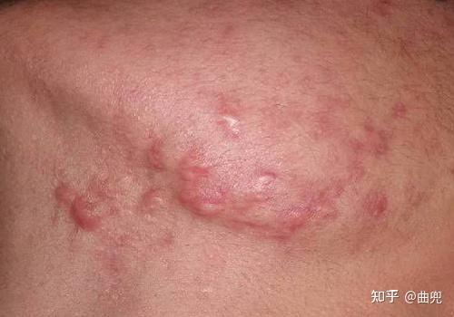 导致痤疮,青春痘的原因有哪些?索尔祛痘护肤分享