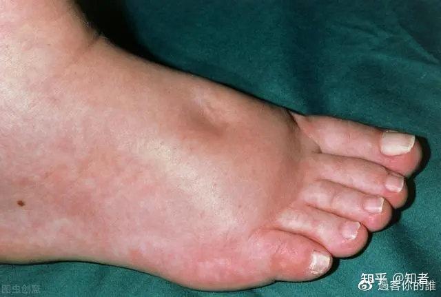 防治肾衰竭不可不重视的4大症状