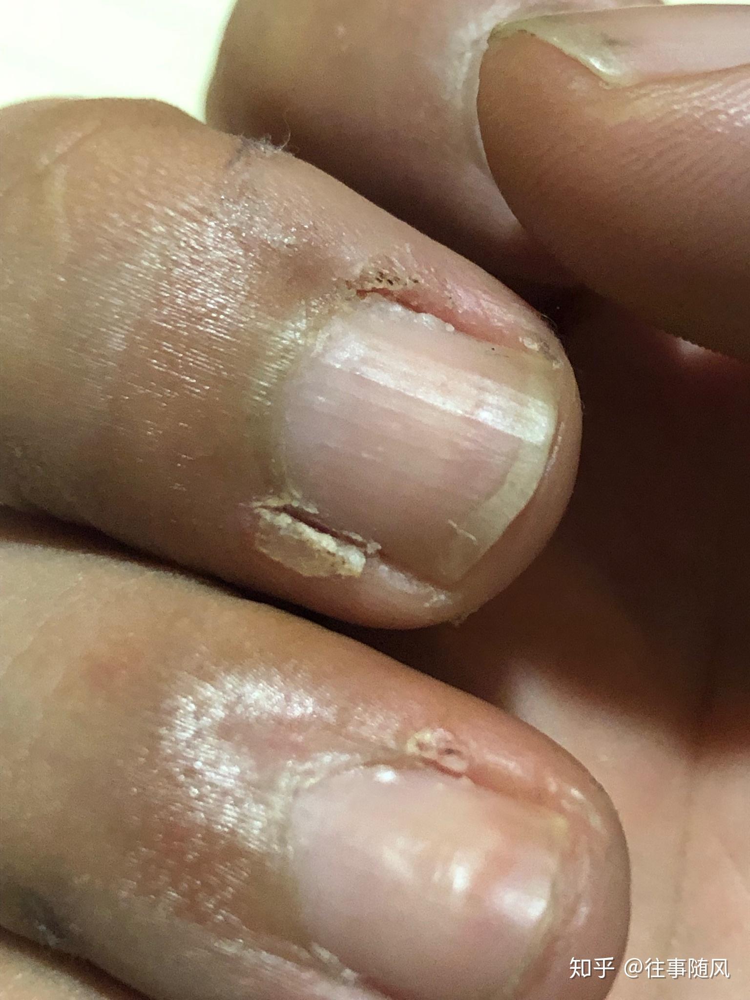 感谢将军提供的治疗甲周疣最强方法