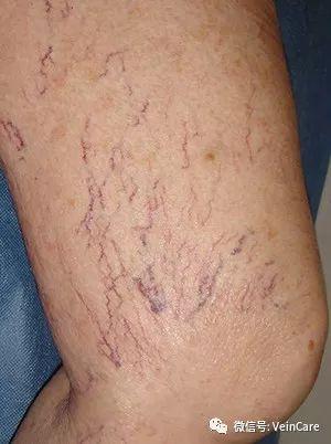 常常有人问我:"发现自己得了静脉曲张,怎么知道是否严重呢?