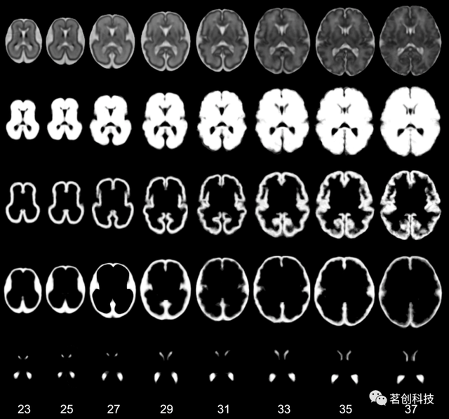 婴儿大脑mri图谱集 - 知乎
