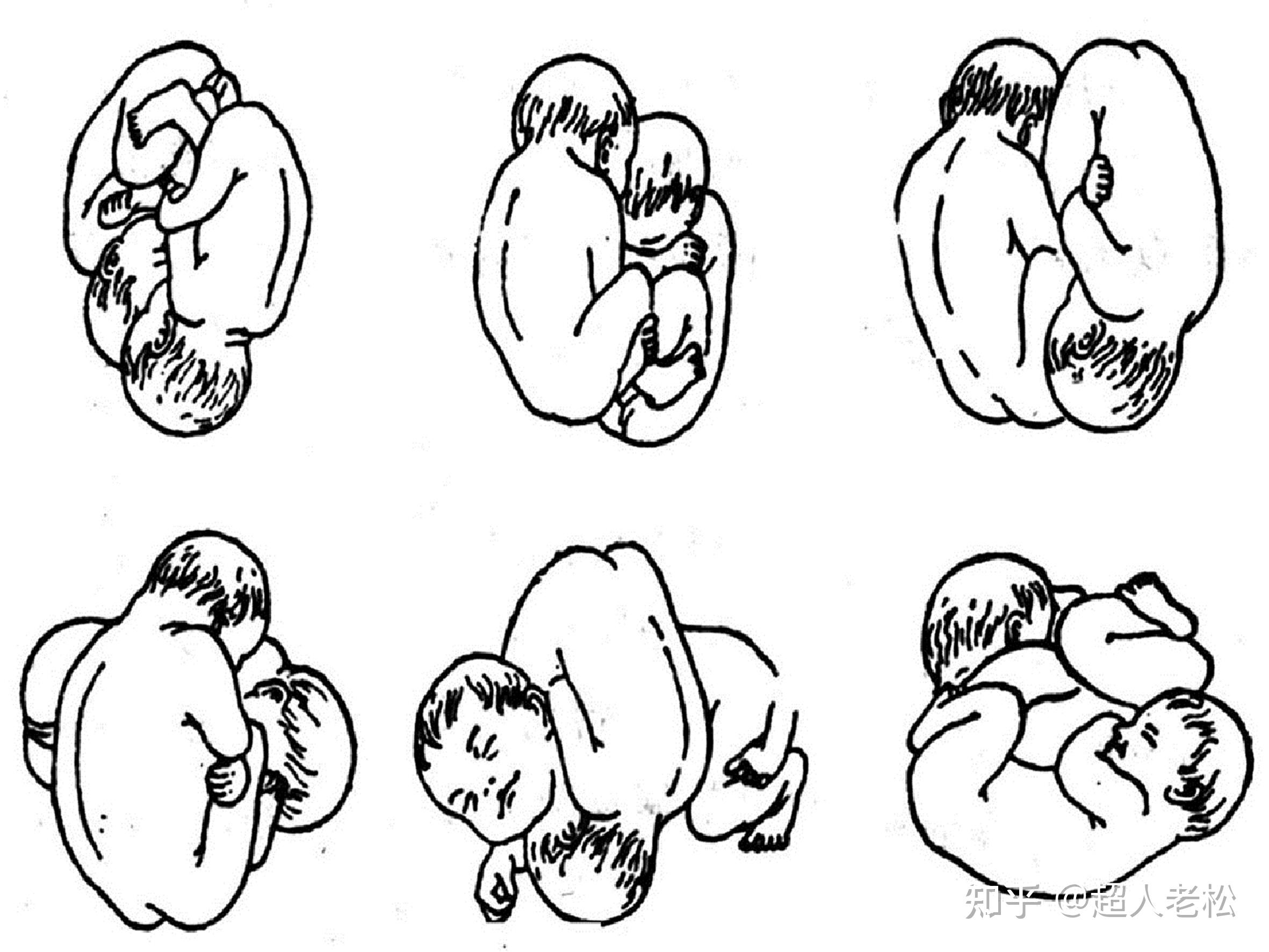 腔内的空间受限,胎儿体位常呈相对固定的胎产式,常见的胎位为纵产式