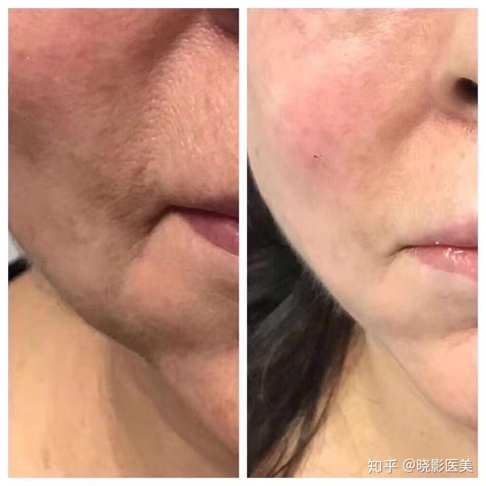 瑞士profhilo五点逆龄提升针正品细节 成分 作用原理 功效展示