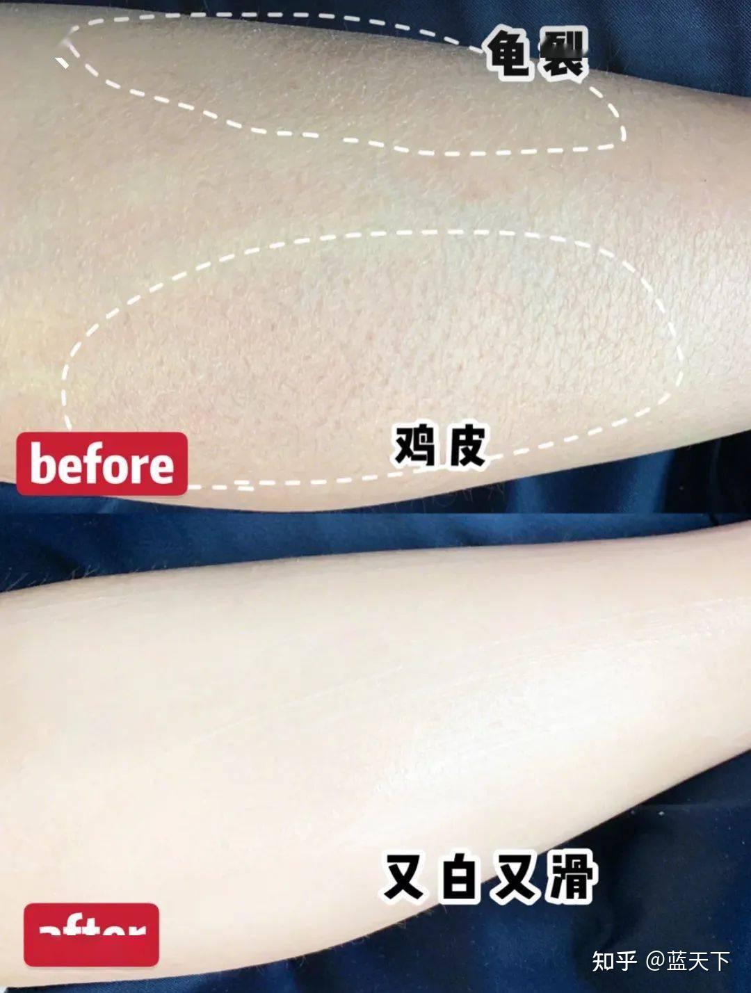 臀部鸡皮肤是什么样的的简单介绍