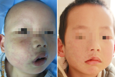 男婴出生半边脸青紫血管瘤长大殃及唇部肿胀
