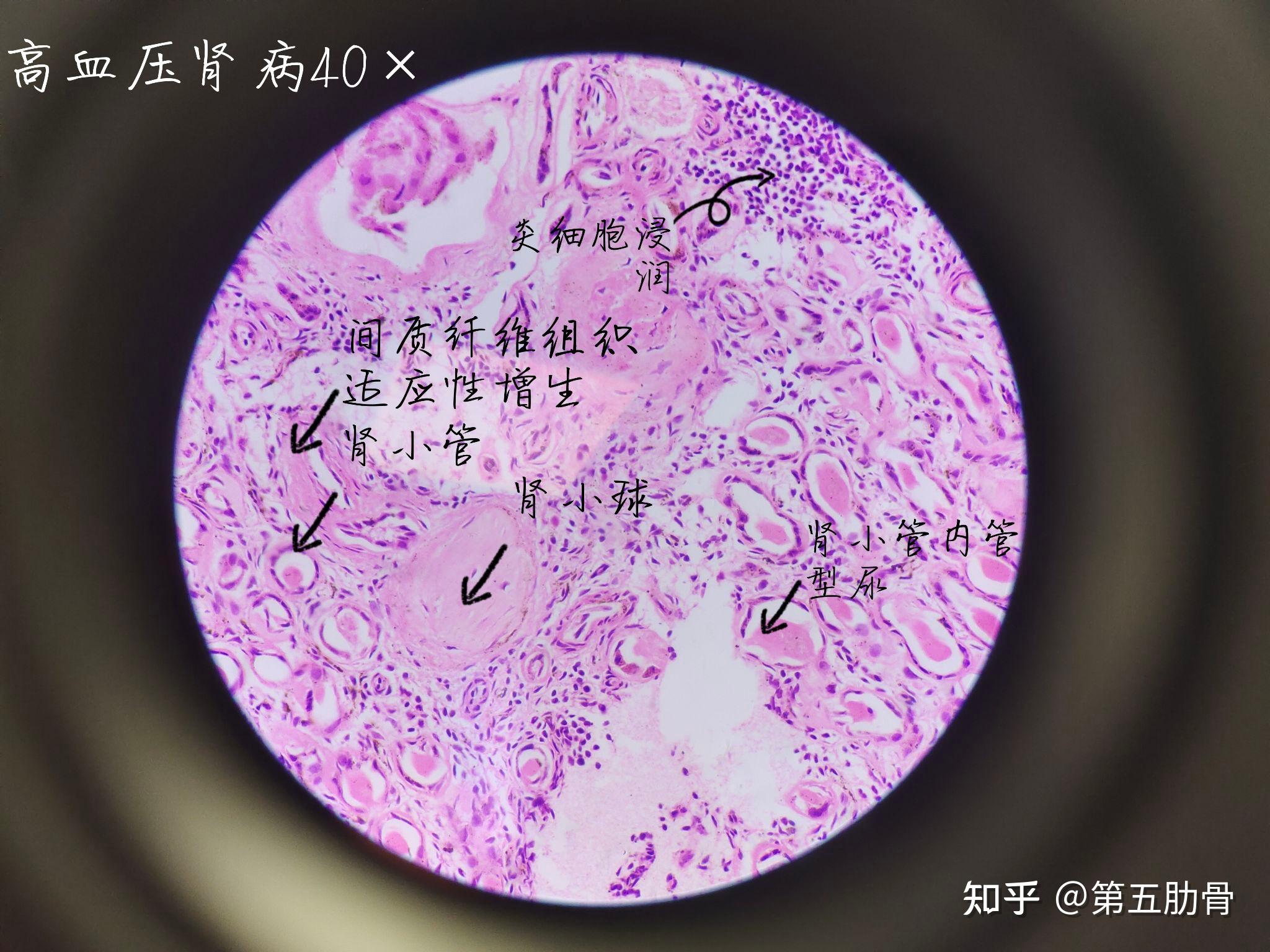 脾包膜图片