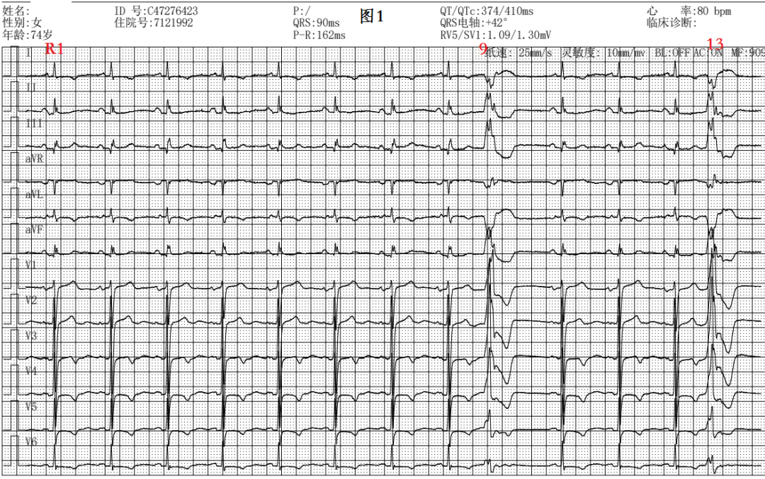 室性早搏三联律心电图图片