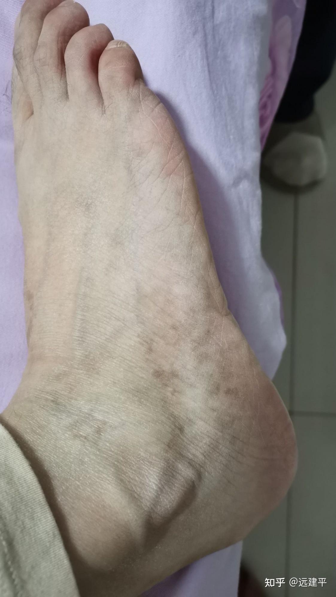 我是怎样与白癜风结缘的(一    求医寻药)