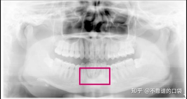 牙根尖囊肿手术 知乎